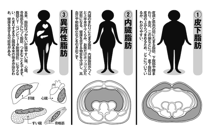皮下脂肪、内臓脂肪、異所性脂肪の違いの図解