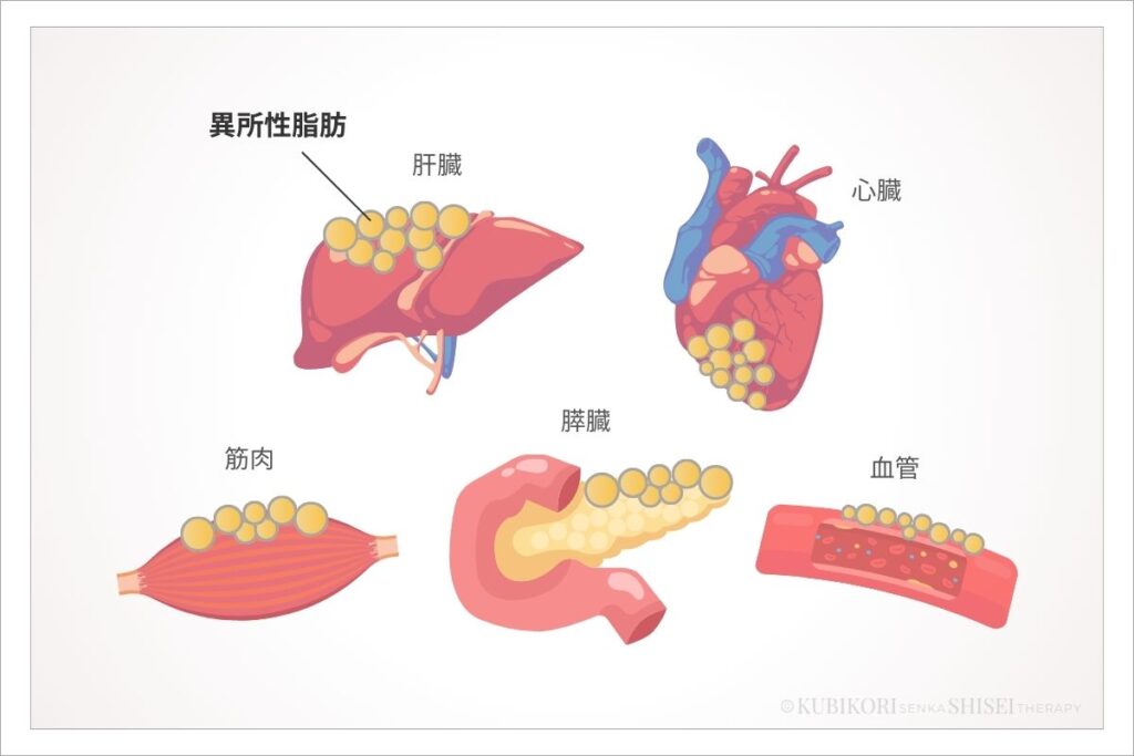 異所性脂肪 第三の脂肪 場違い脂肪のイメージ