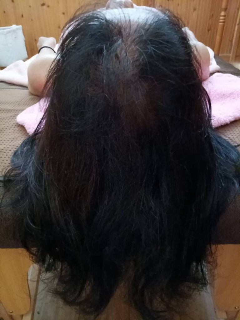 フジタ式首コリ整体で約3ヶ月施術を受けた40代女性の頭頂部。地肌に産毛が生え始めた様子