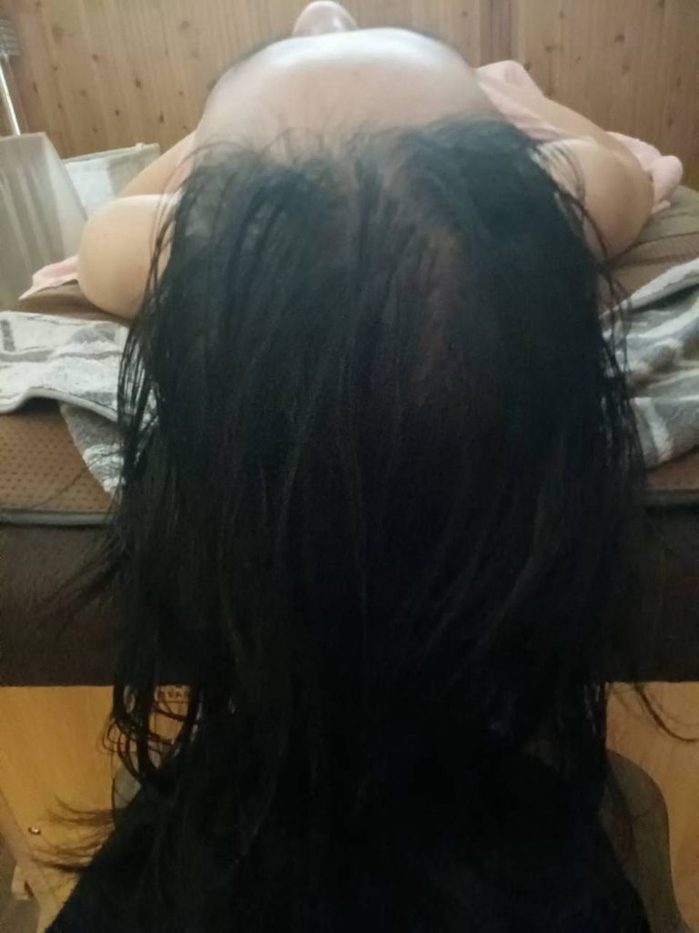 首コリ整体とヘッドマッサージを約半年続けた40代女性の頭頂部。分け目が目立ちにくくなった様子